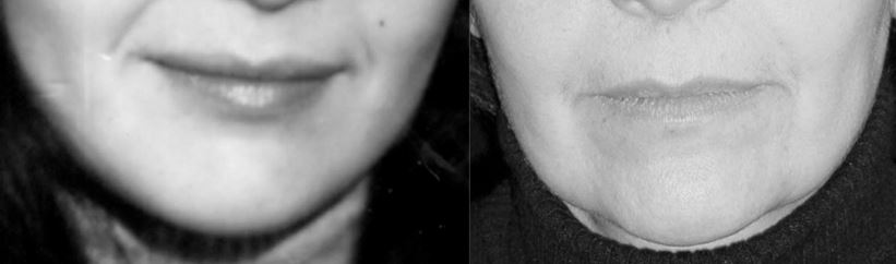 Mini lifting sans chirurgie : tout savoir sur ce traitement de la médecine esthétique